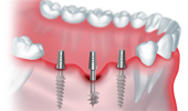 Имплантация – современный способ спасения зубов