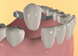 Адгезивное протезирование: мостовые протезы в клинике «Интердентос»