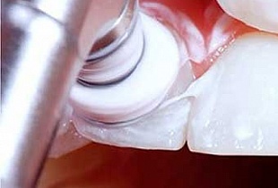 Чистка зубов ClinPro