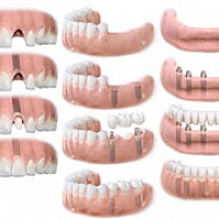 Разновидности зубных имплантатов